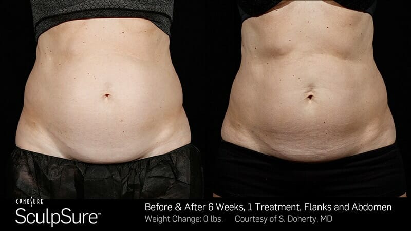 A before and after photo of a Sculpsure treatment of female abdomen and flanks after 6 weeks and one treatments.