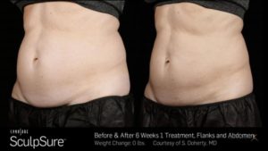 Tummy tuck before and after.