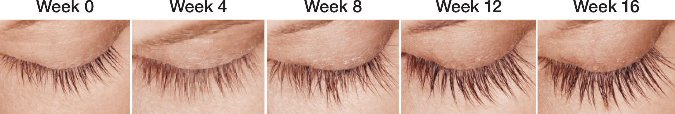 latisse before after photo