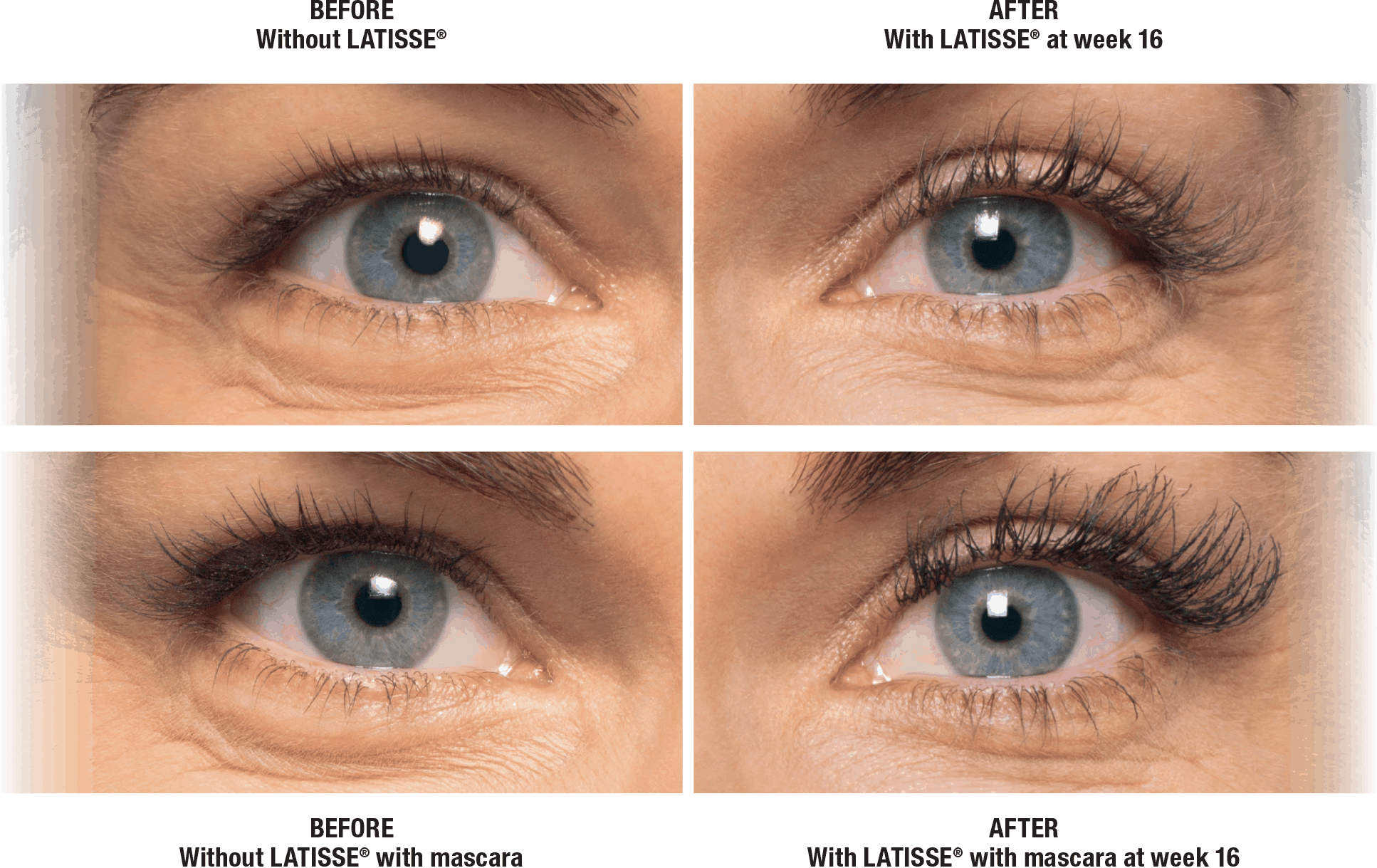 latisse chicago before after photo