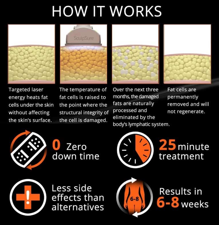 how does sculpsure work