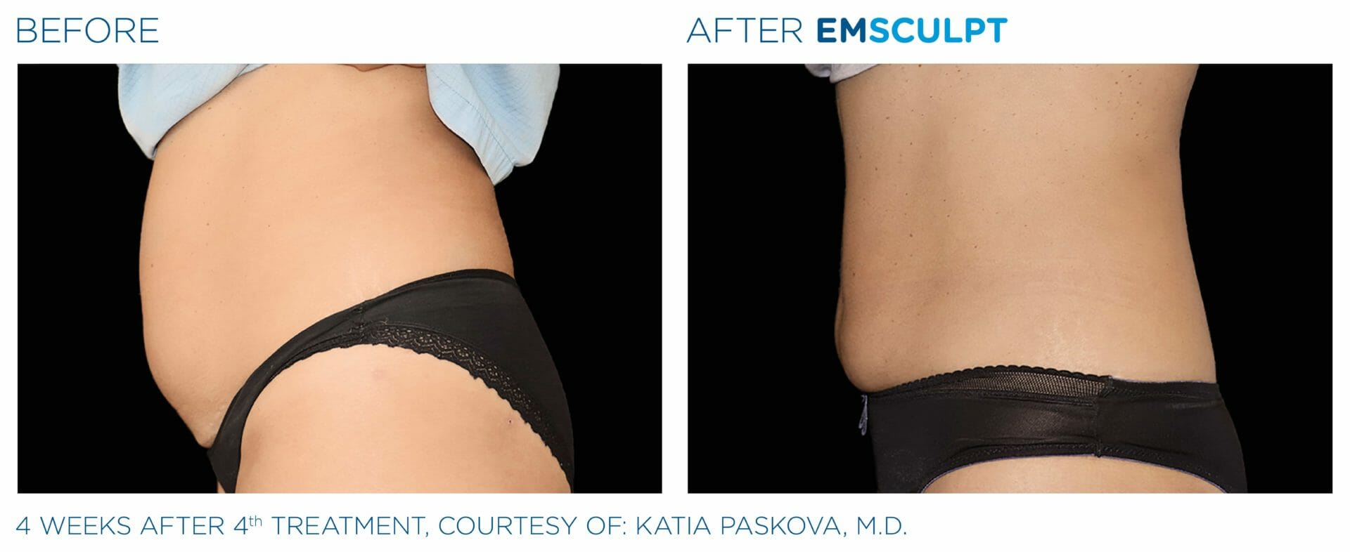 emsculpt before and after photo