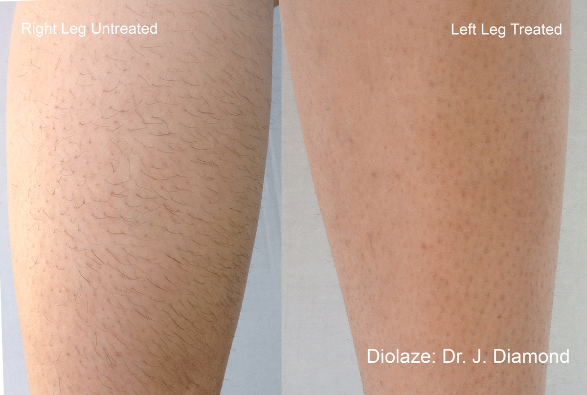 laser hair removal before after legs