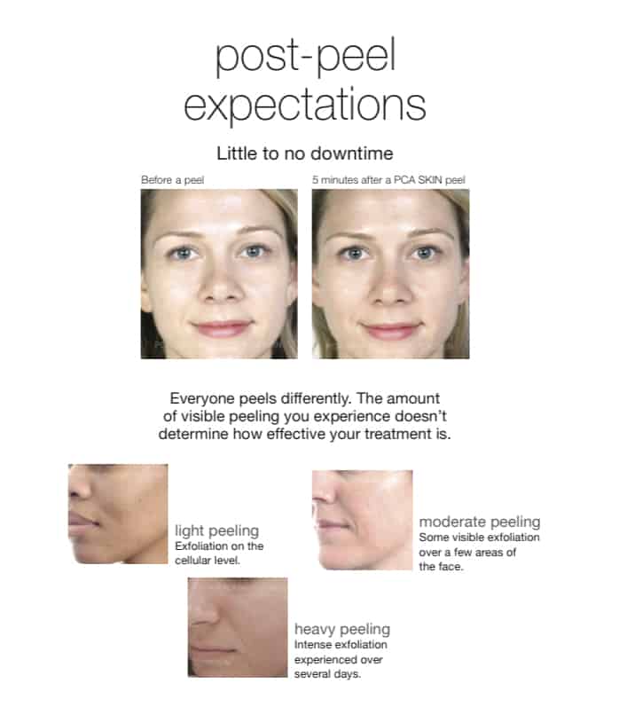 chemical peel treatment instructions chicago aesthetics