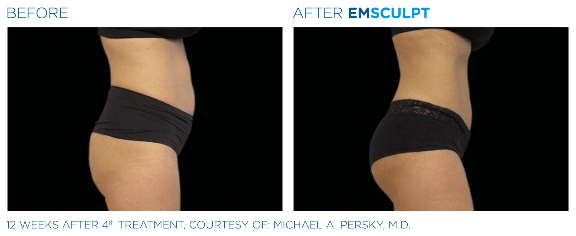 non surgical butt lift emsculpt