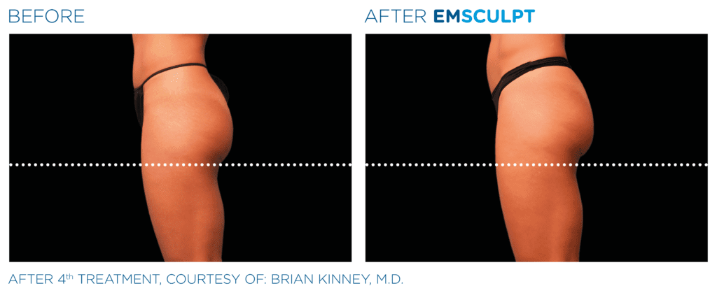 non surgical butt lift emsculpt