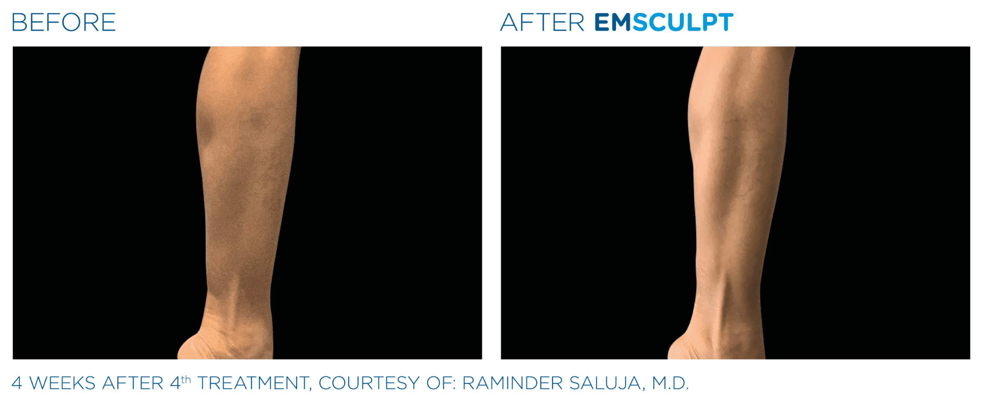 emsculpt legs before after