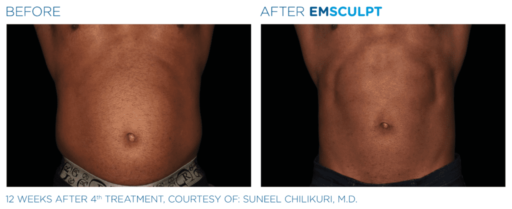 emsculpt abdomen before after