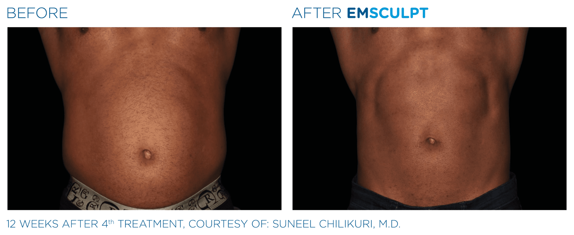 emsculpt abdomen before after