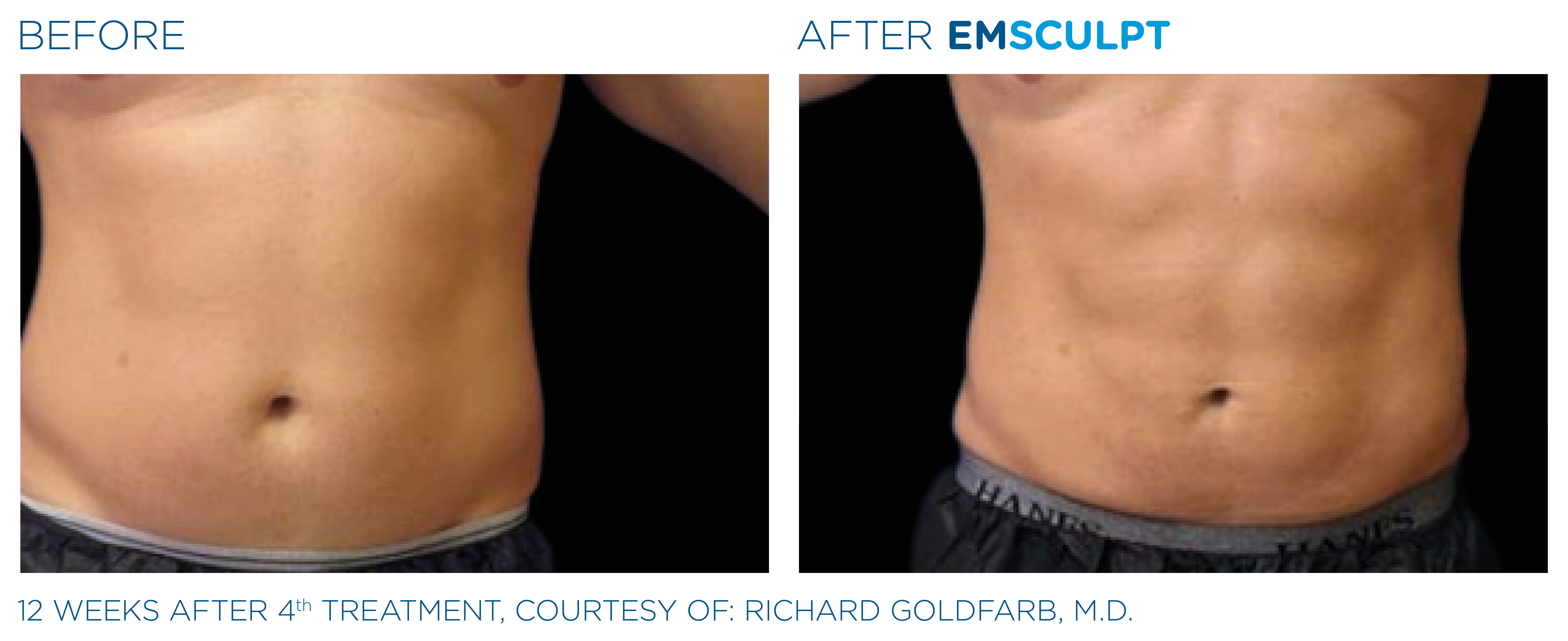 emsculpt abs before after