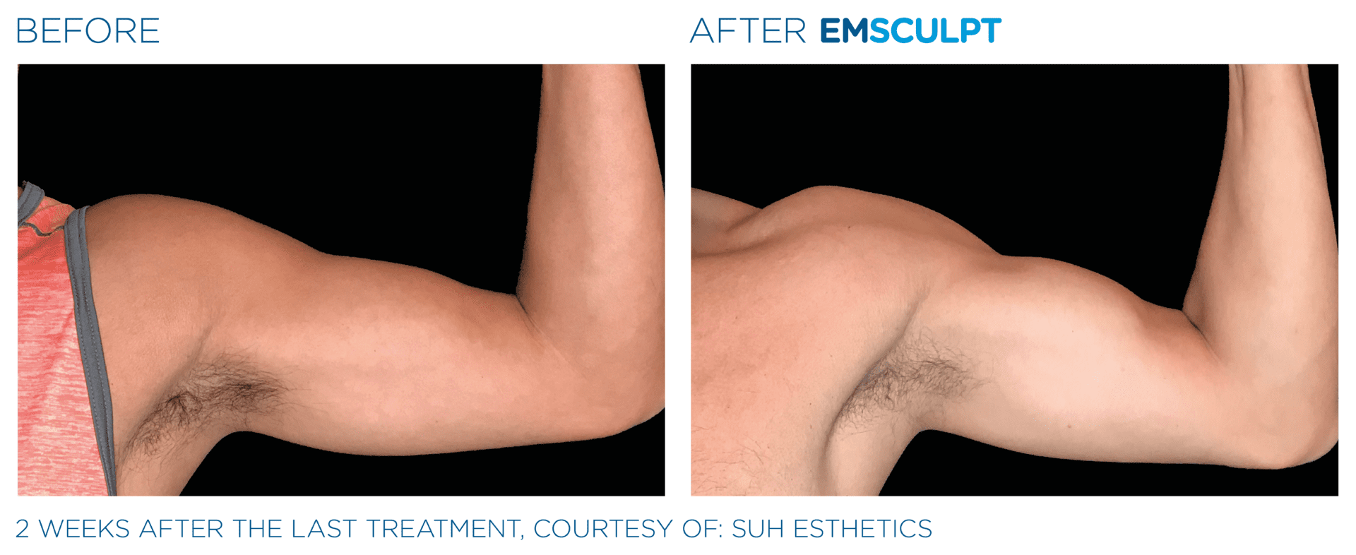 emsculpt arms near me