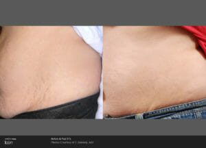 laser stretch mark before after