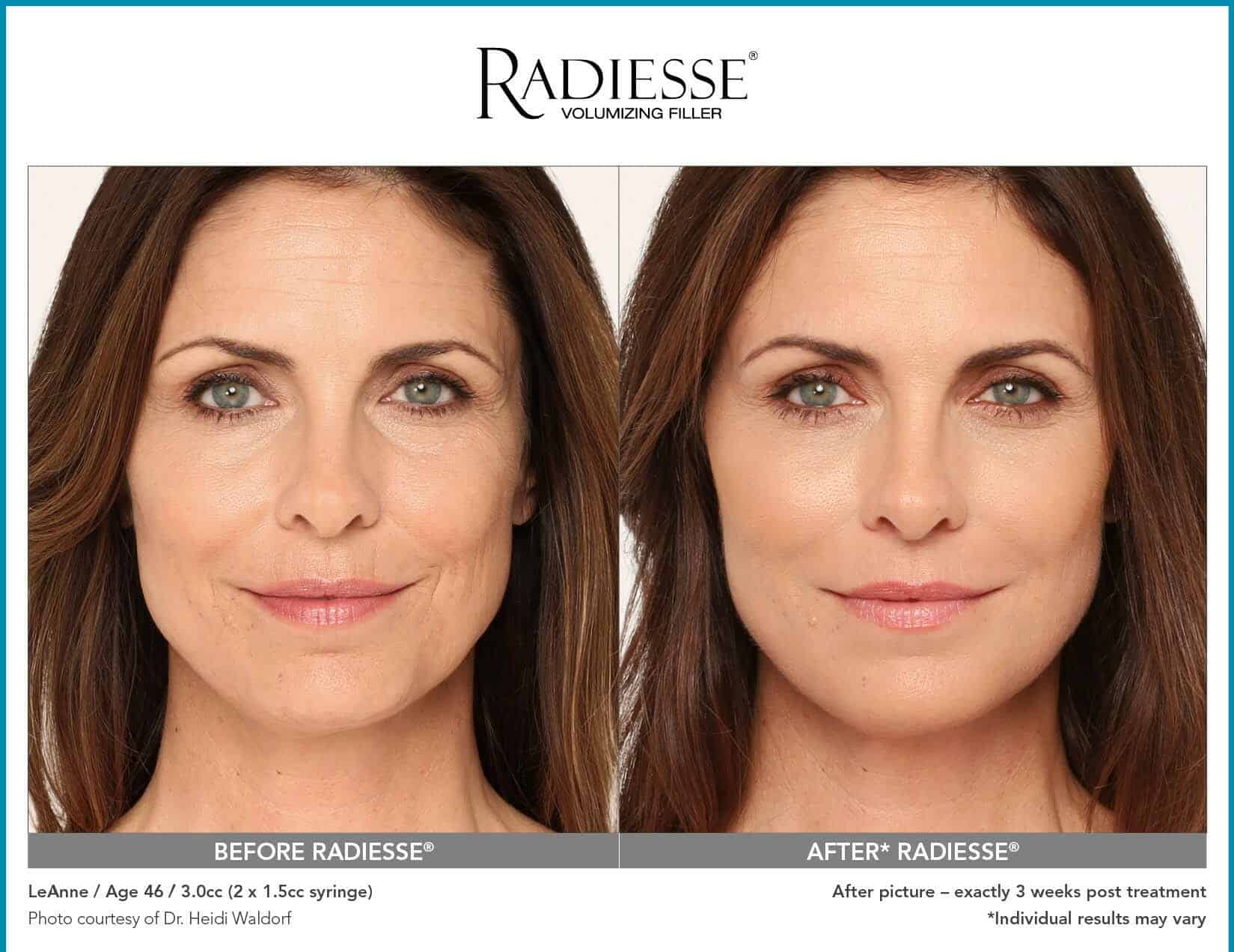 how does radiesse work