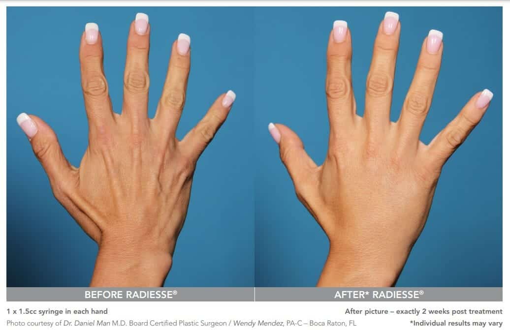 radiesse hand rejuvenation