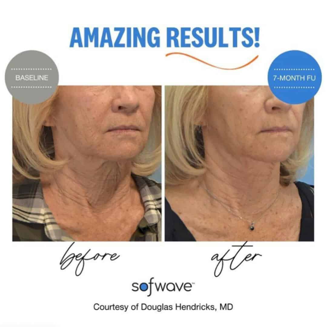 Sofwave before and afters 9