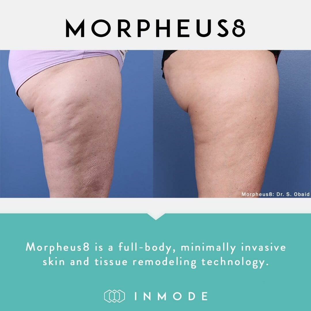 mopheus8-near-me-before-after-3-1 copia