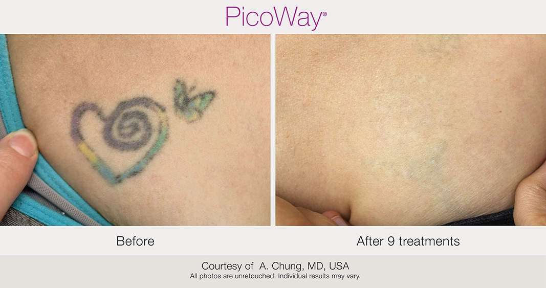 BA-PicoWay-AChung-ChestTattoo-9tx-min copia