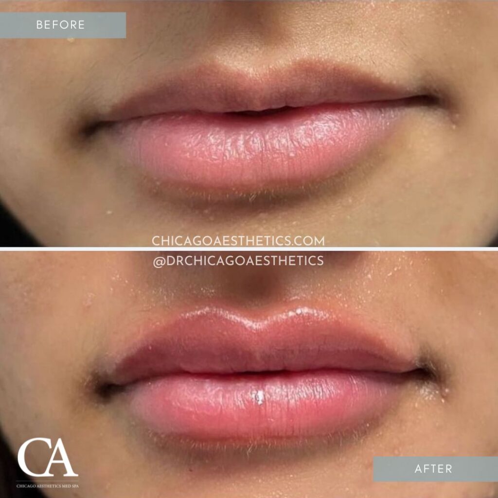 #108 Lip Injections Before After Chicago Aesthetics