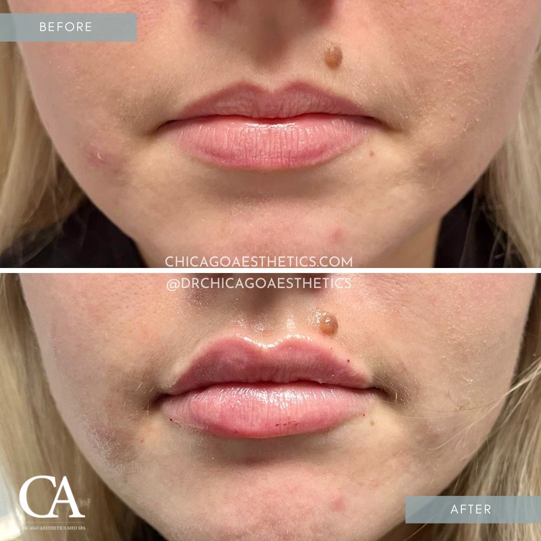 #108 Lip Injections Before After Chicago Aesthetics