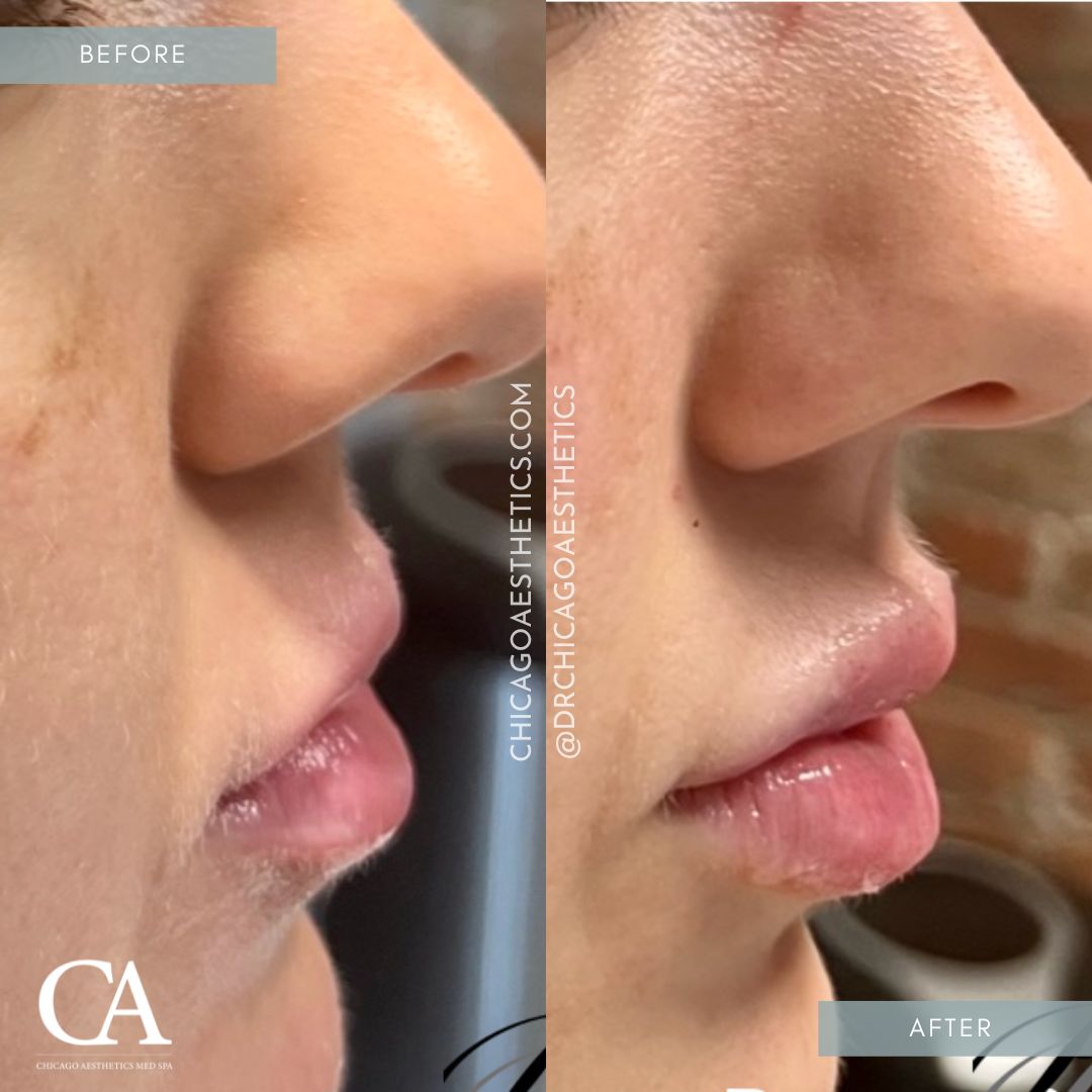 #108 Lip Injections Before After Chicago Aesthetics