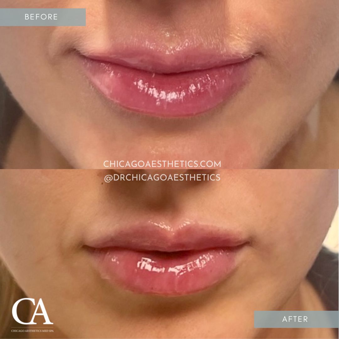 #108 Lip Injections Before After Chicago Aesthetics