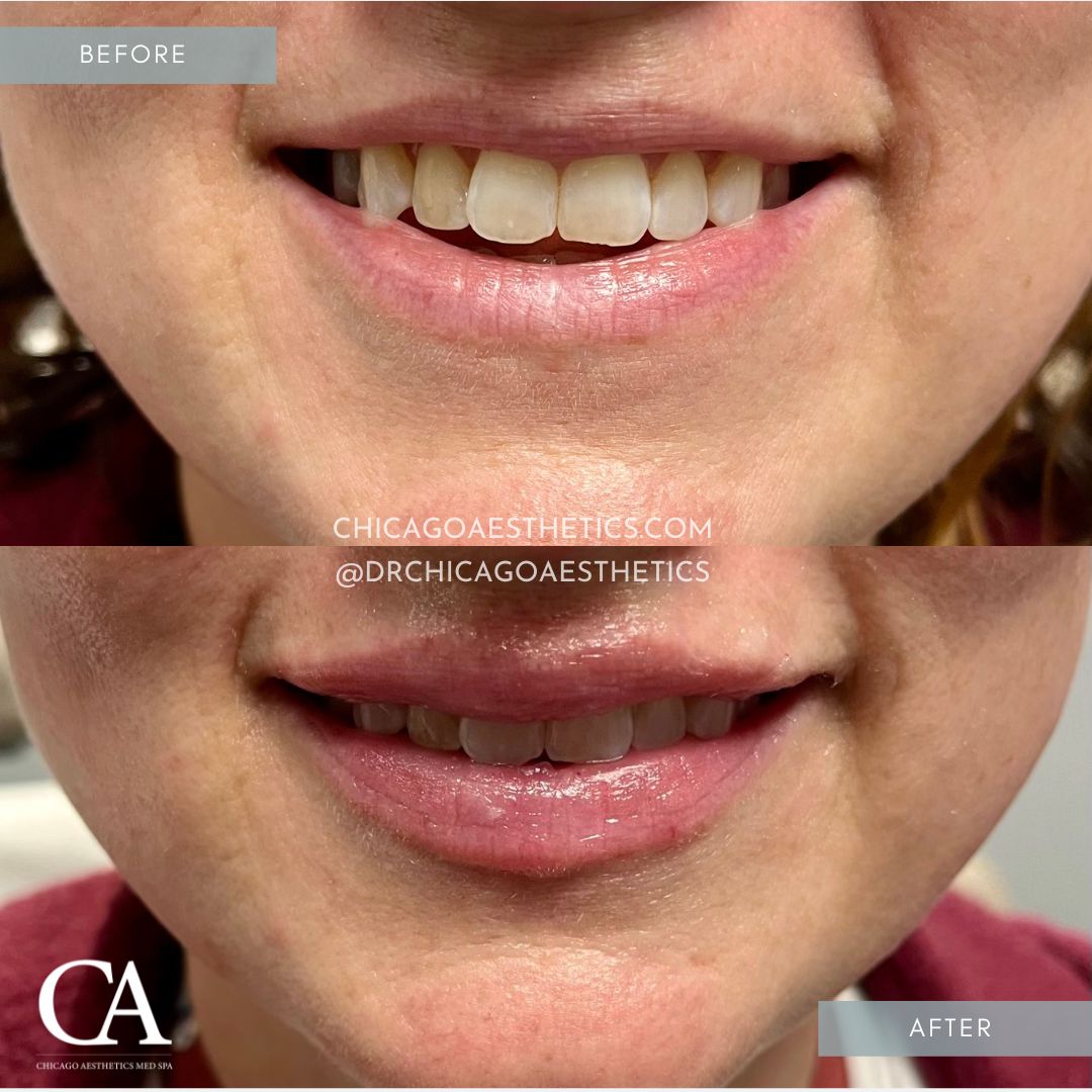 #108 Lip Injections Before After Chicago Aesthetics
