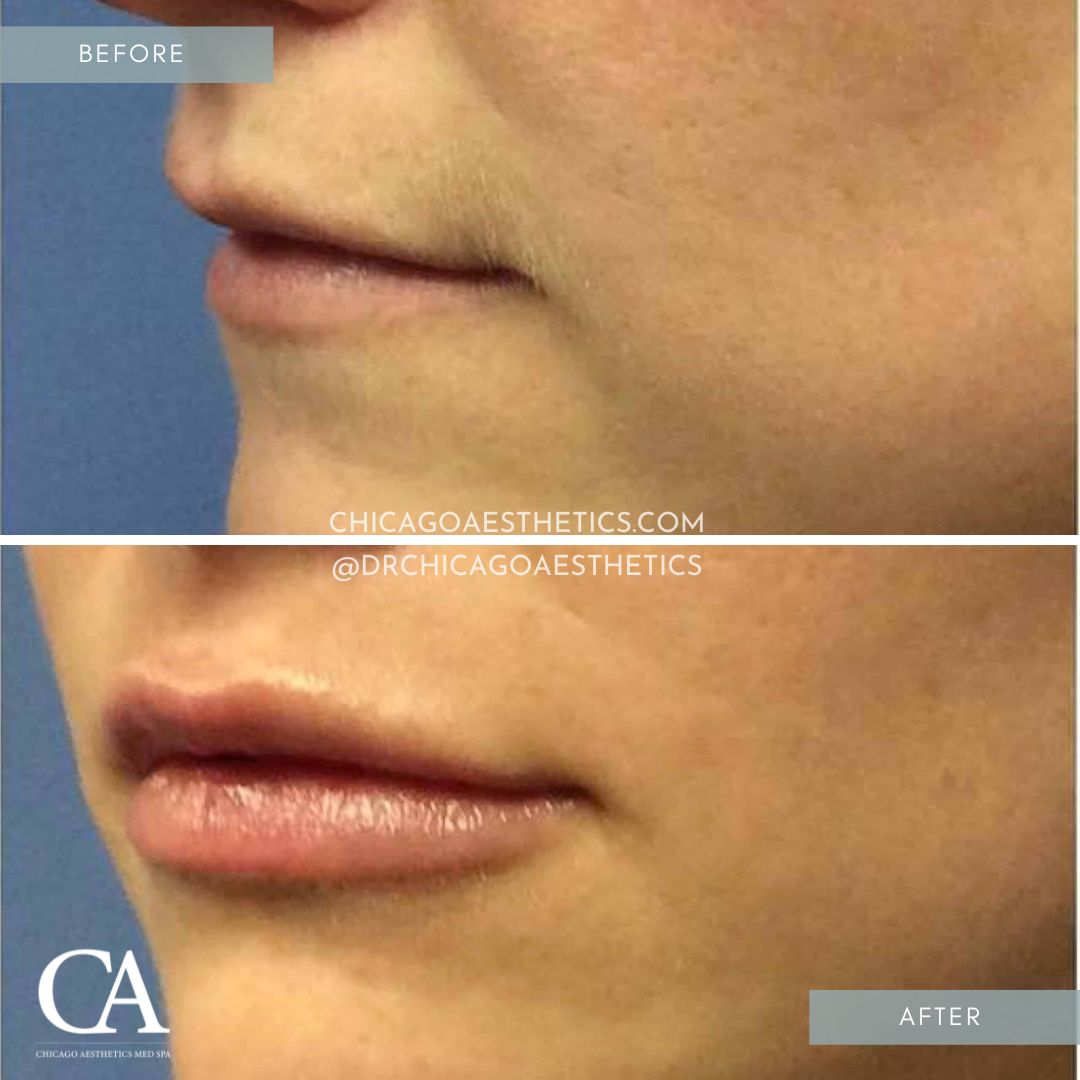 #114 Lip Filler Before After Juvederm Chicago Aesthetics