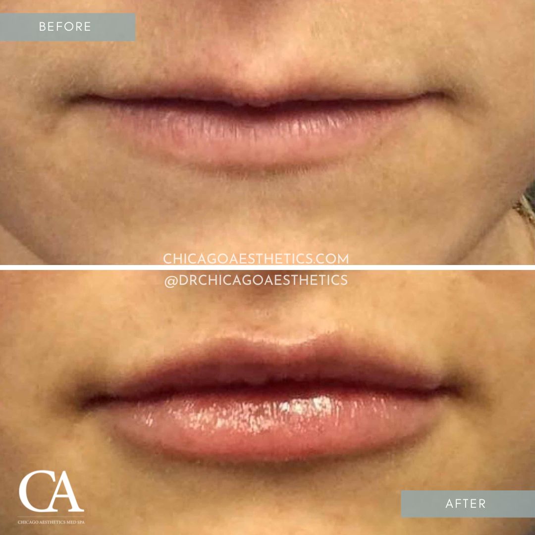 #114 Lip Filler Before After Juvederm Chicago Aesthetics
