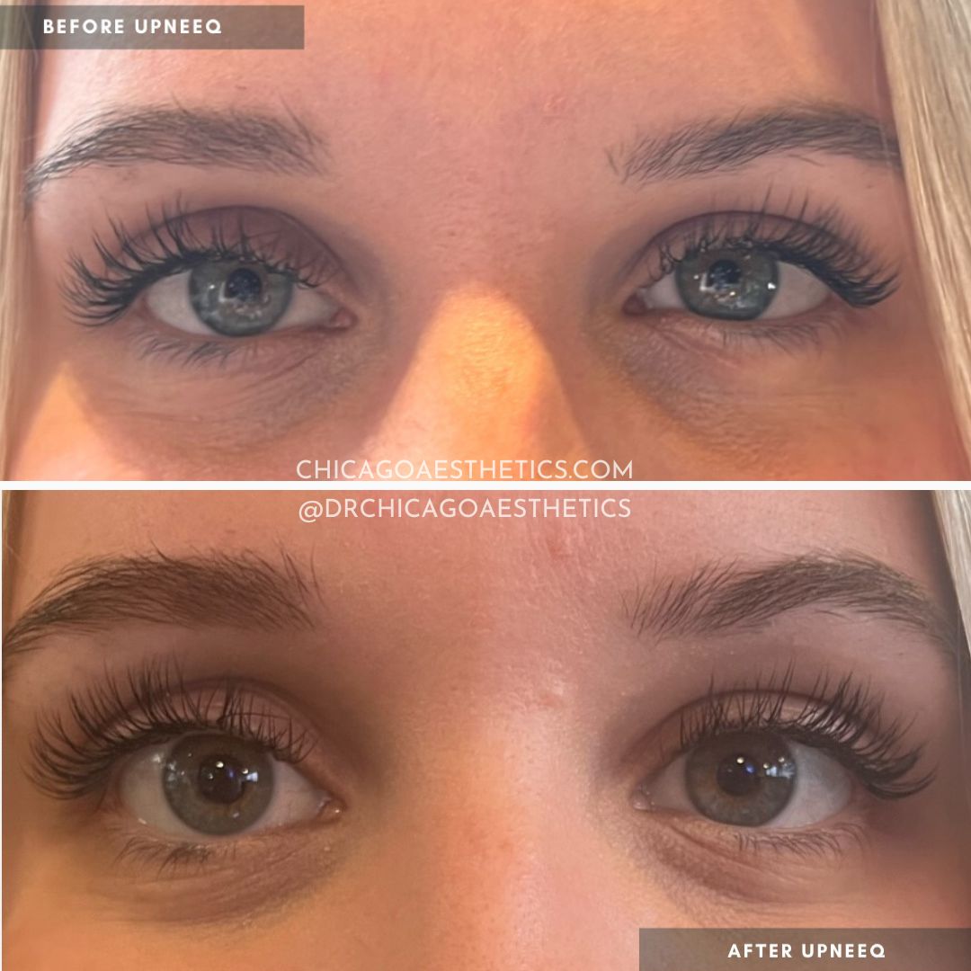 #150 Upneeq Before After Chicago Aesthetics