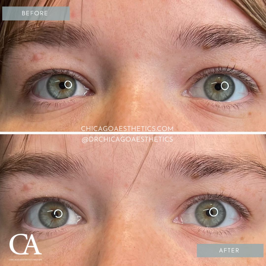 #151 Upneeq Before After Chicago Aesthetics