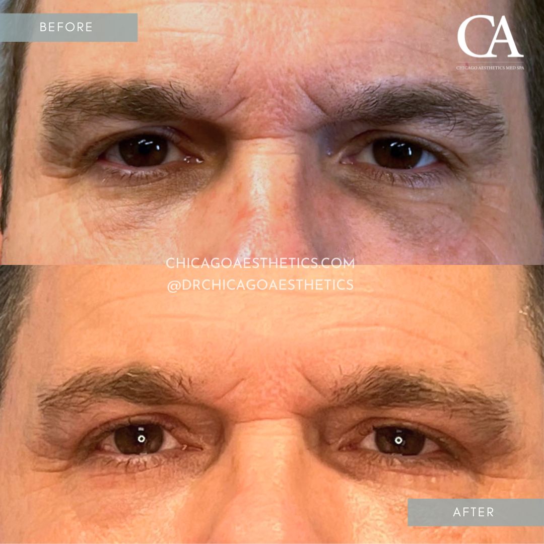 #160 Dermal Filler Under Eye Before After Chicago Aesthetics