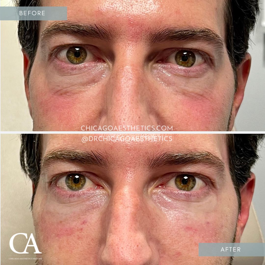 #162 Dermal Filler Under Eye Before After Chicago Aesthetics