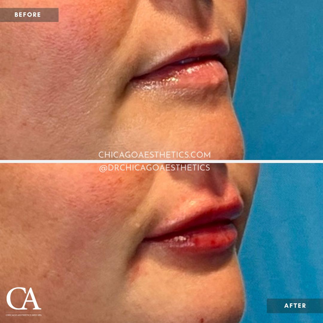 #201 Lip Filler Revanesse Versa 1.2ml Chicago Aesthetics