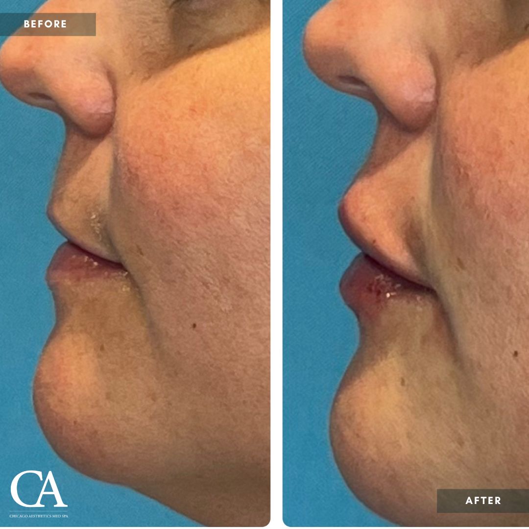 #201 Lip Filler Revanesse Versa 1.2ml Chicago Aesthetics