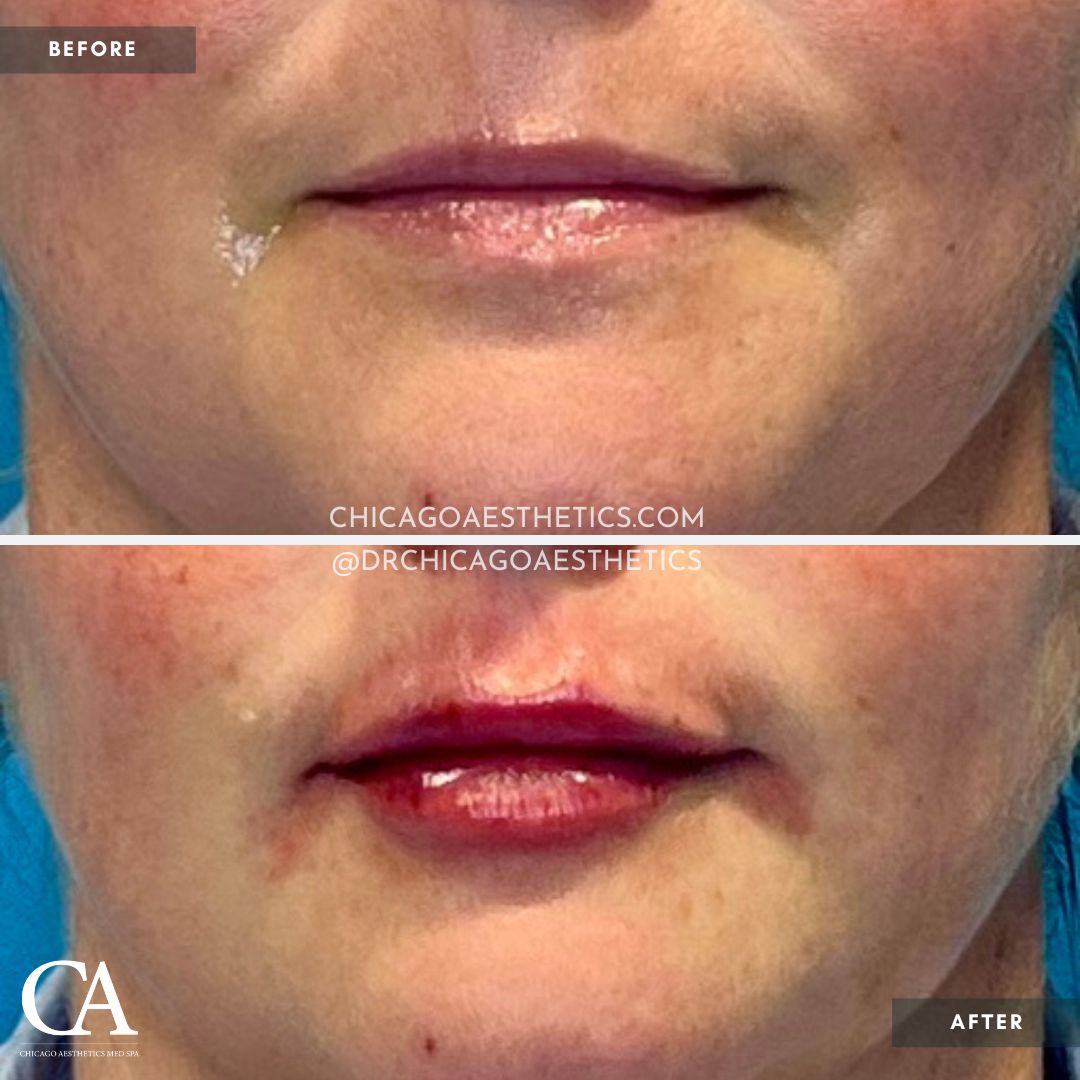 #201 Lip Filler Revanesse Versa 1.2ml Chicago Aesthetics