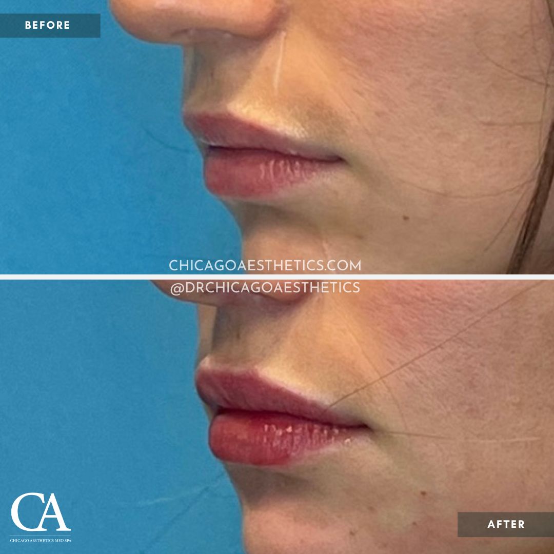 #202 Lip Filler Restylane Defyne Before After Chicago Aesthetics