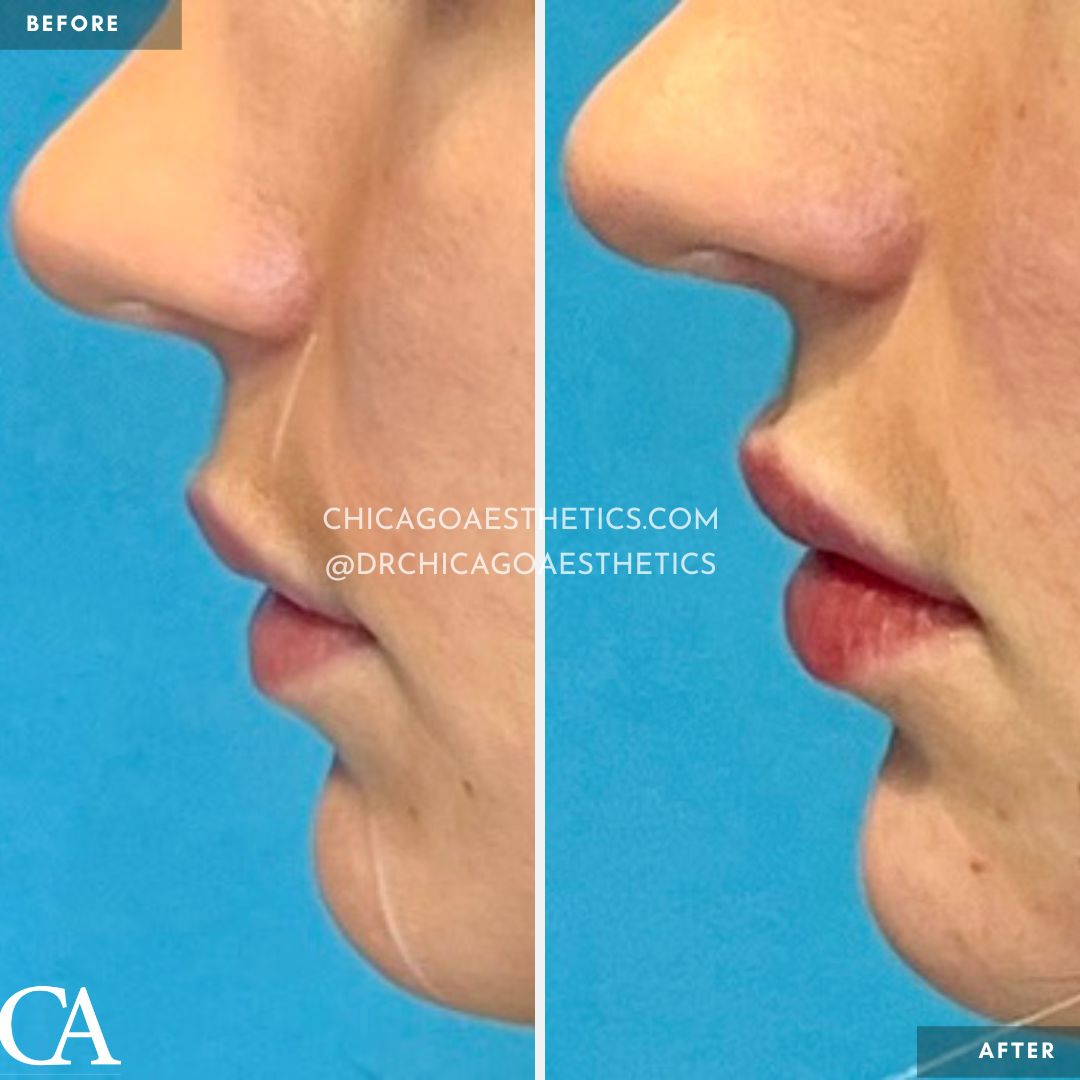 #202 Lip Filler Restylane Defyne Before After Chicago Aesthetics