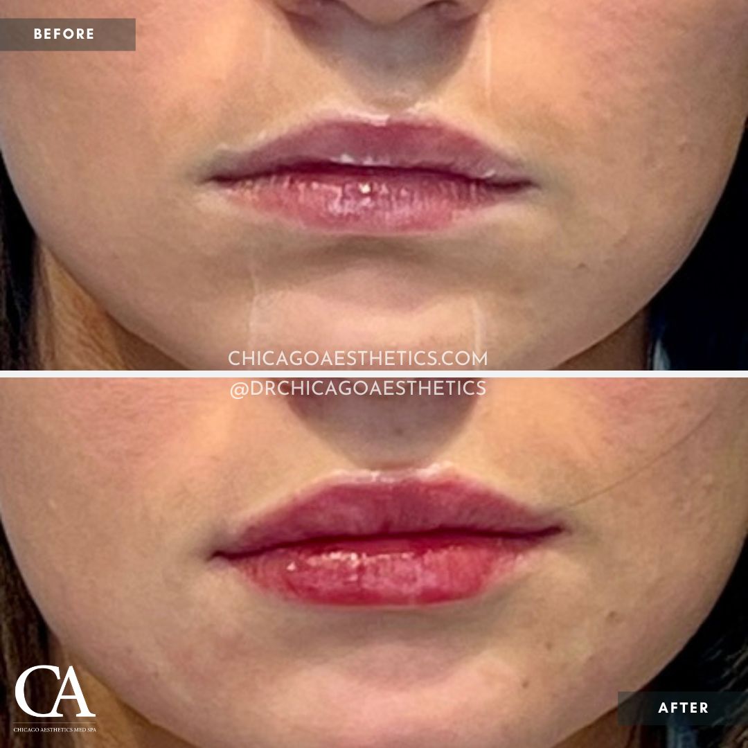 #202 Lip Filler Restylane Defyne Before After Chicago Aesthetics