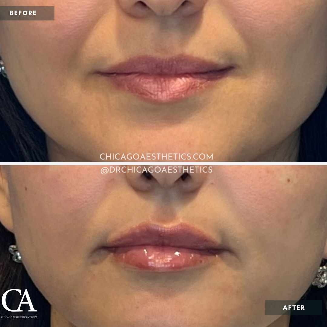 #203 Lip Filler Revanesse Versa 1.ml Chicago Aesthetics