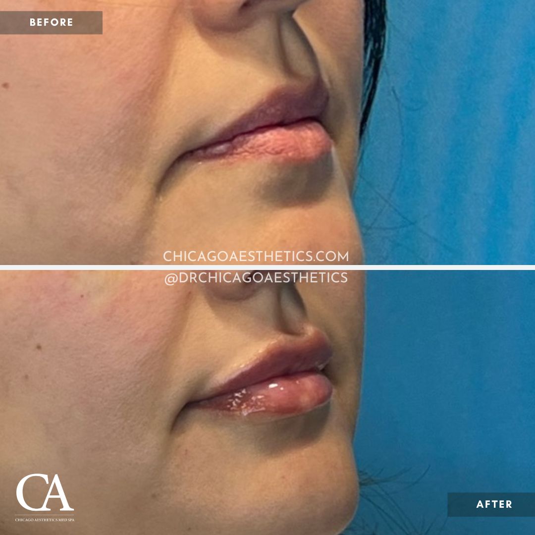 #203 Lip Filler Revanesse Versa 1.ml Chicago Aesthetics