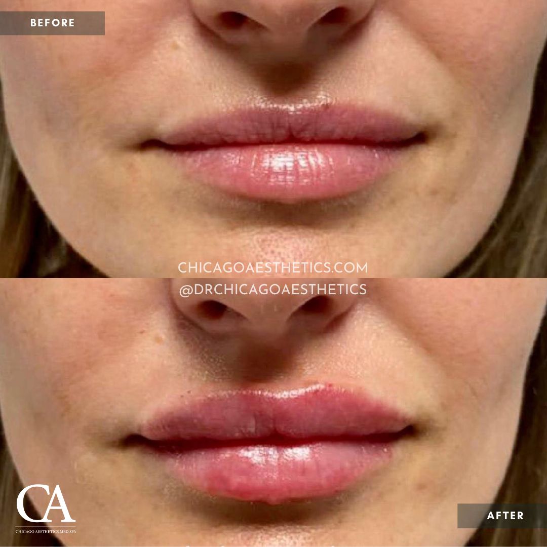 #204 Lip Filler Before After Chicago Aesthetics - CD