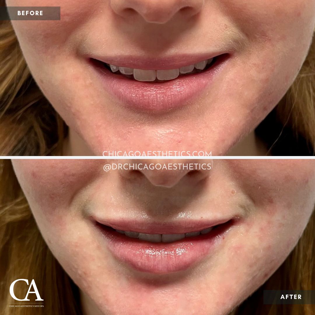 #205 Lip Filler Before After Chicago Aesthetics CD