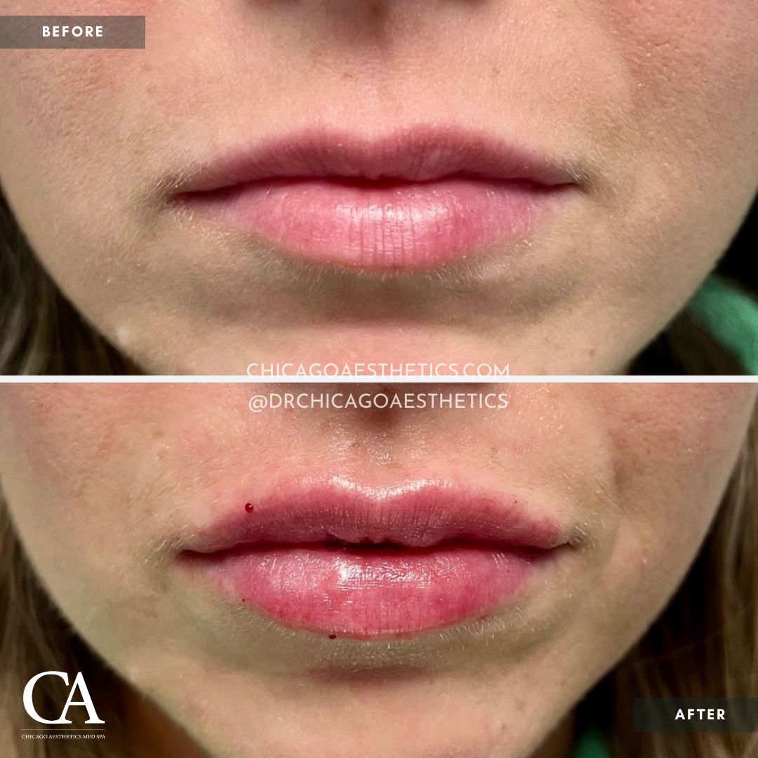 #206 Lip Filler Before After Chicago Aesthetics - CD