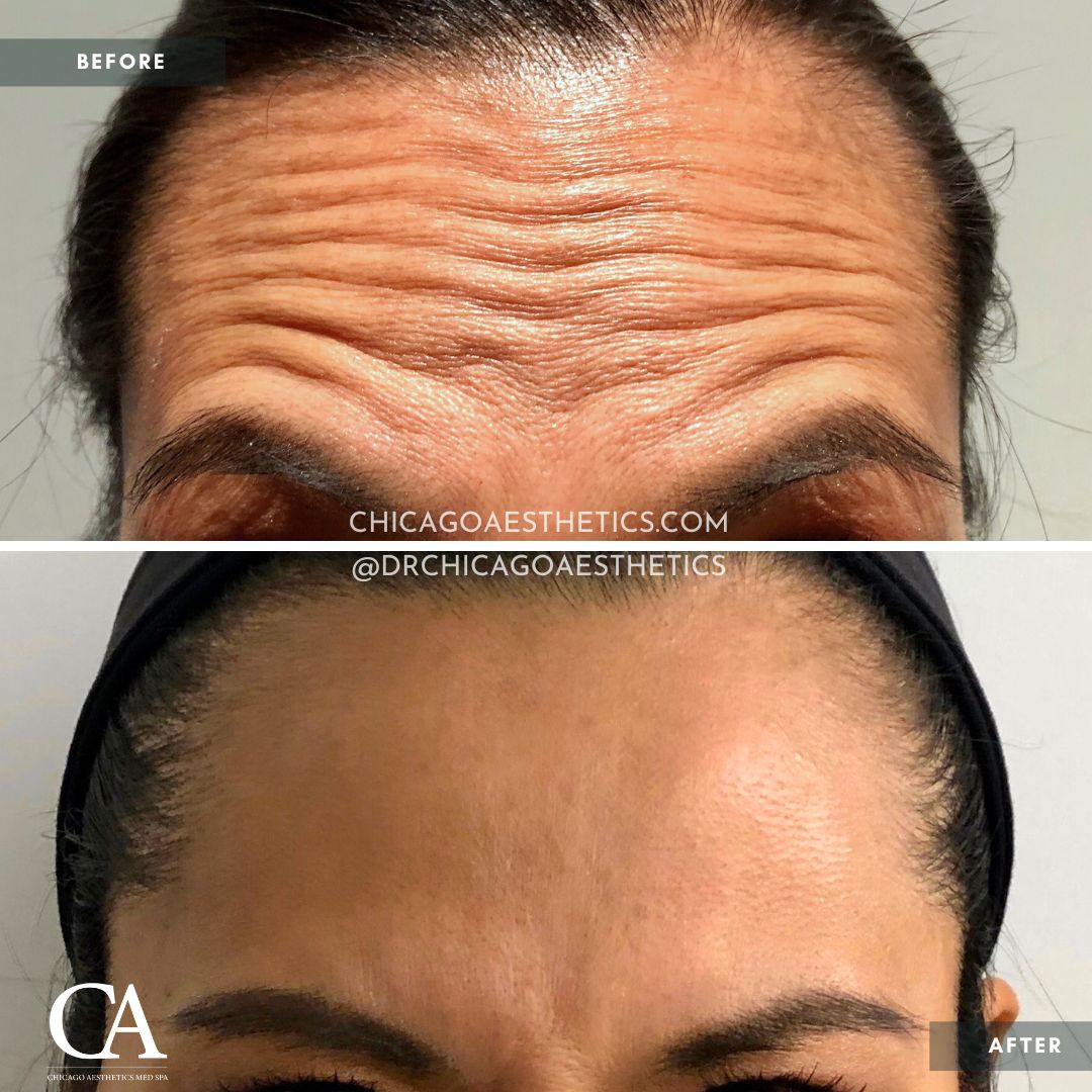 #207 Dysport Before After Chicago Aesthetics