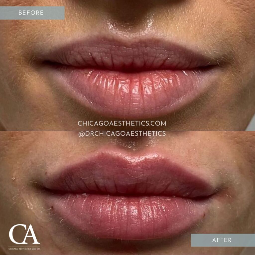 #301 Lip Injections Before After Chicago Aesthetics