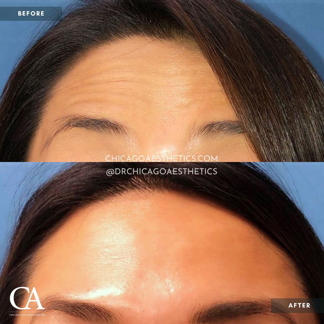 #301 Dysport Forehead Before After Chicago Aesthetics
