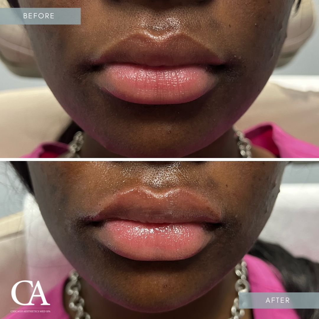 #301 Lip Injections Before After Chicago Aesthetics