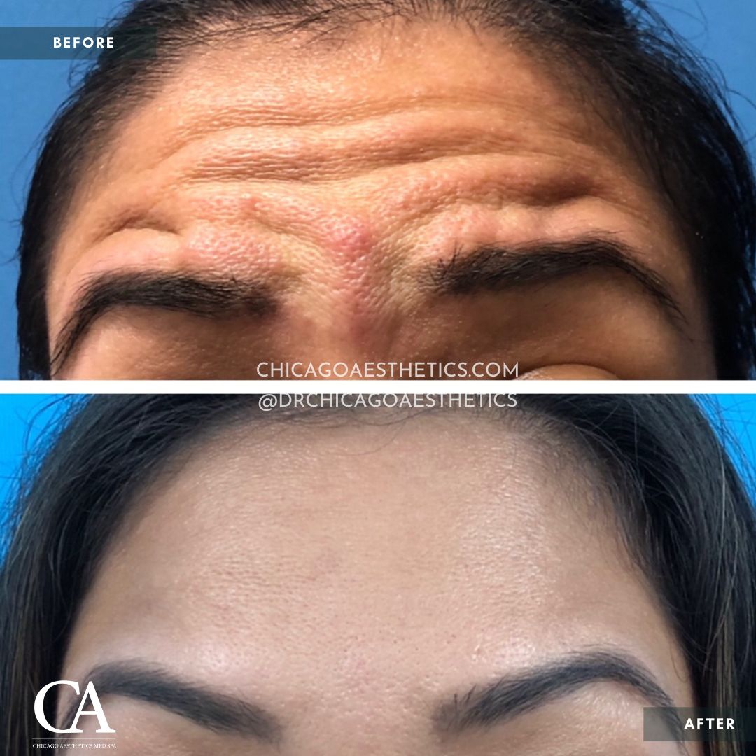 #304 Dysport Forehead Before After Chicago Aesthetics