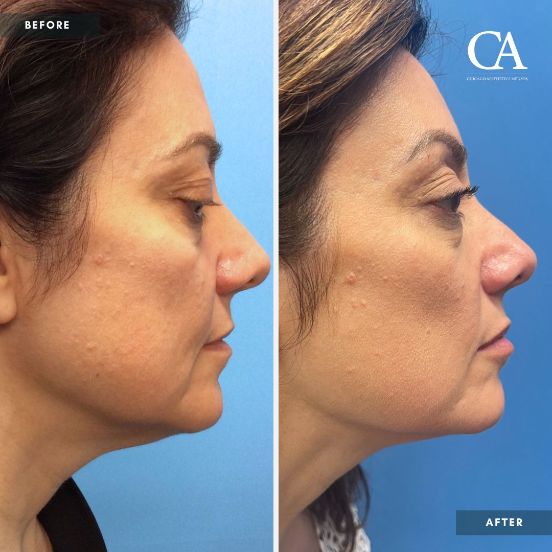 Sofwave before after photo Chicago Aesthetics