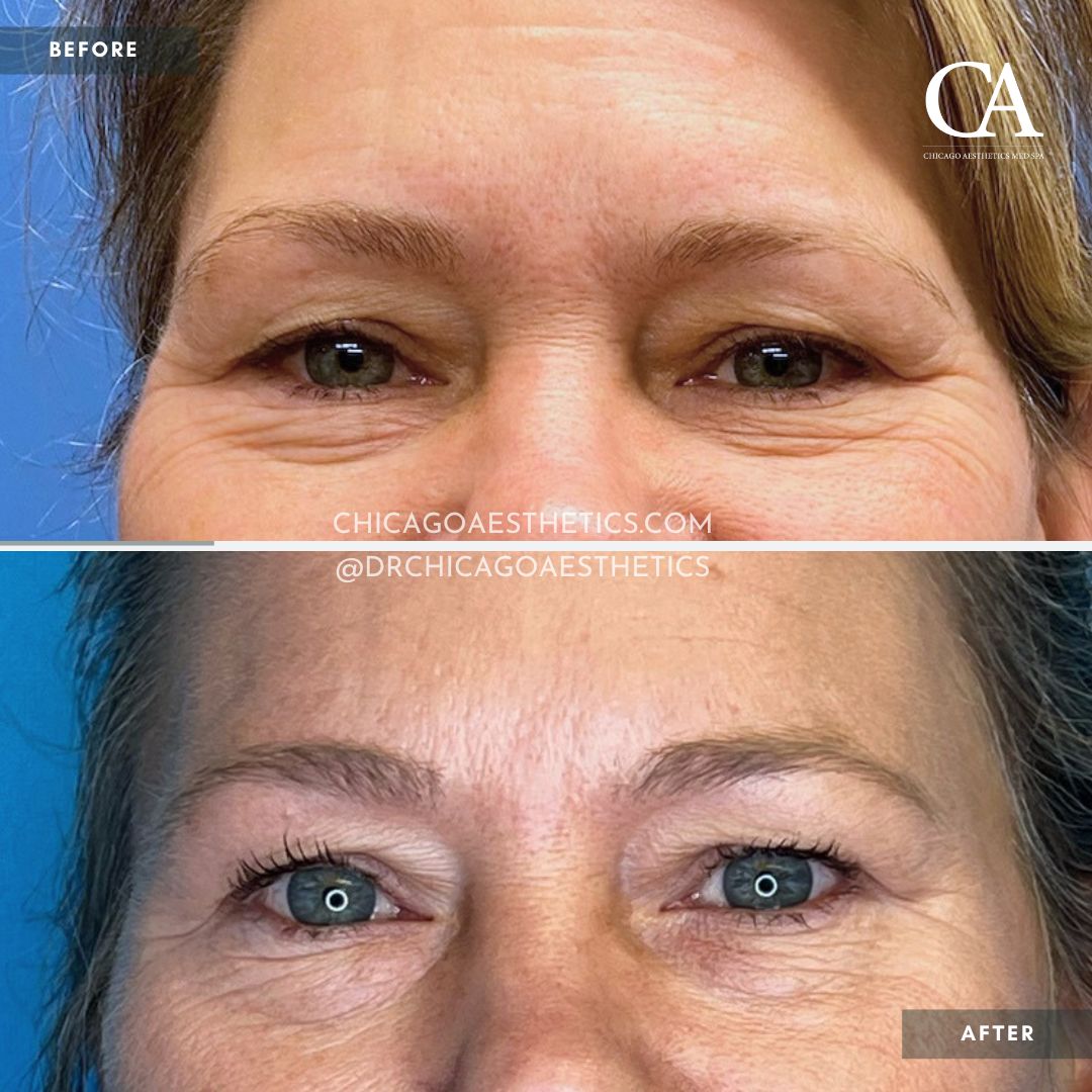 #502 Sofwave Before After Chicago Aesthetics